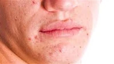 4. بشړة صافية خالية من حب الشباب: حلم أصبح حقيقة
